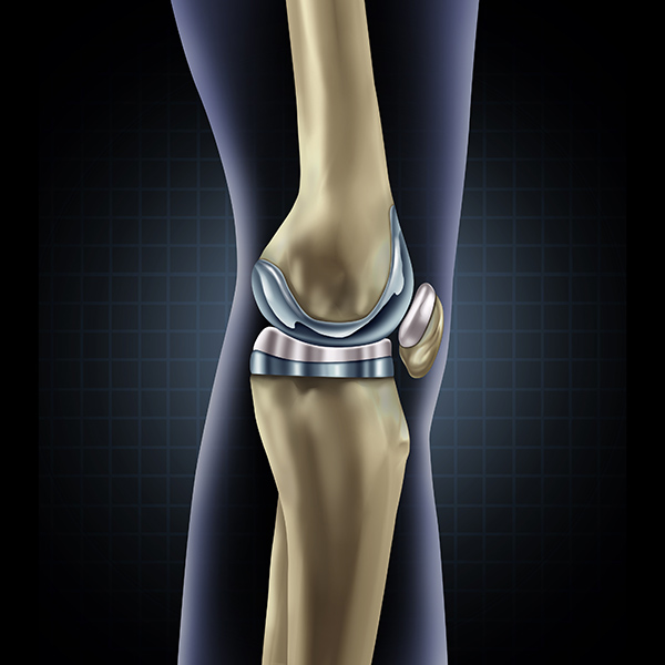Protesi al ginocchio su misura: Un “miracolo” per tre donne